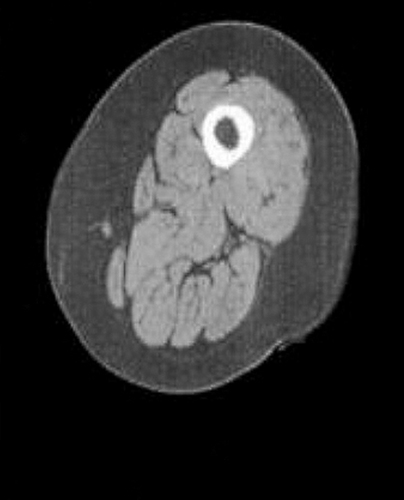 Figure 2 MRI of the same patient with moderate degree of obstruction, but evident sarcopenia. In the cross section of the subject’s leg it is possible to notice a reduced muscle mass (light gray area), and a pronounced area of subcutaneous and intramuscular fat (dark gray area).