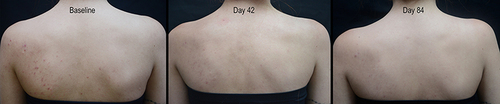 Figure 1 Female patient with acne on the upper back at baseline and after 42 and 84 days of care.