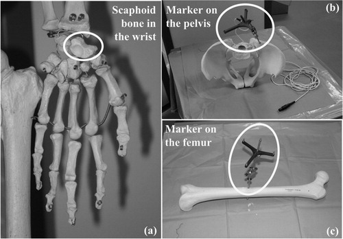 Figure 1. Problems of preoperative-CT- and intraoperative-fluoroscopy-based CAOS systems.