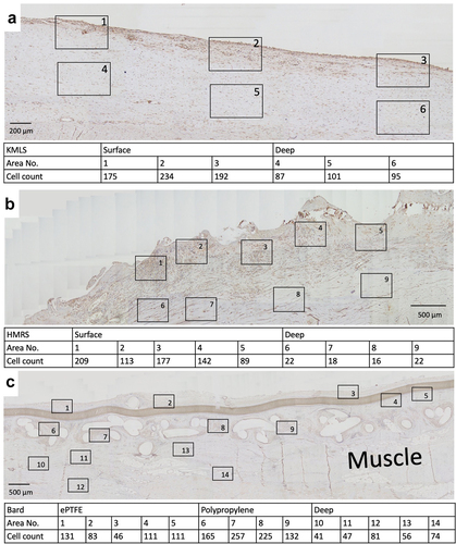 Figure 7. Immunohistochemical staining for S100A4. (a) Micrograph of tissue from revision by KMLS. The square indicates the counted HPF. The numbers of S100A4-positive cells are shown. (b) Micrograph of tissue from revision by HMRS. The numbers of S100A4-positive cells are shown. (c) Micrograph of tissue from wide resection with mesh. The numbers of S100A4-positive cells are shown.