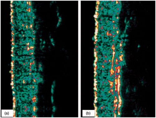 Figure 2. Skin density before (a) and after 12 weeks of treatment with formula A (b). A typical ultrasound B-scan shows the density and thickness of the dermis before and after 12 weeks of treatment; obtained from a volunteer of group 1.