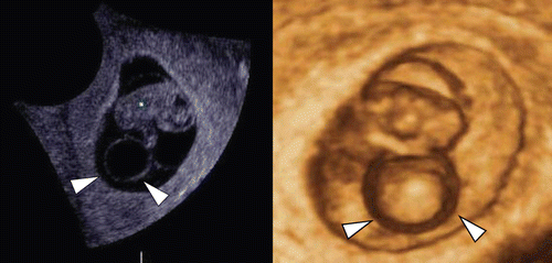 Figure 19.  Large yolk sac (arrowheads) at 8 weeks of gestation. (left) 2D sagittal section of the fetus. Normal appearance of 8-week-fetus and amniotic membrane are visible, but large yolk sac with 12 mm of diameter is demonstrated. (middle) regular fetal heart rate of 174 bpm is confirmed. (right) 3D image intrauterine fetal demise was confirmed 30 hours later. Villous chromosome exam resulted in doubled trisomy of 48, XY, +15, +21.