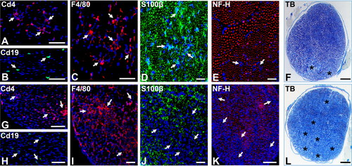 Figure 1. Severe murine experimental autoimmune neuritis in adult female SJL mice. Representative digital photomicrographs of axial cryostat 10 µm and glutaraldehyde-fixed, osmium tetroxide post-fixed, epoxy resin-embedded, toluidine blue-stained 1 µm sciatic nerve sections from sm-EAN-affected female SJL mice 2–3 days after disease onset (A-F) and at peak severity (G-L) are shown. Foci of Cd4+ T-cells (A, white arrows) associated with rare Cd19+ B-cells (B, white arrows) and more diffuse foci of F4/80+ macrophages (C, white arrows) are seen during the early stages of sm-EAN. Infiltrating leukocytes are associated with Schwann cell membranes (D, white arrows) with some focal reduction in axon density (E, white arrows). Foci of demyelination with axonal degeneration occur in association with endoneurial leukocyte infiltration (F, asterisk).At peak severity, there is further leukocyte infiltration with more diffuse foci of Cd4+ T-cells (G, white arrows), persistent Cd19+ B-cell infiltration (H, white arrows) and increased foci or near confluent infiltration of F4/80+ monocytes/macrophages (I, white arrows). Leukocyte infiltration is associated with foci or near confluent loss of Schwann cell membranes (J, white arrows), consistent with demyelination, as well as reduction in axonal density (K, white arrows), consistent with axonal loss. Multiple foci or near confluent regional demyelination and axonal degeneration (L, asterisk) occurs with endoneurial leukocyte infiltration at peak severity. S100β: marker of myelinating Schwann cell membranes; NF-H: Neurofilament-heavy chain, marker of axon intermediate filaments, TB: toluidine blue. Scale bars: A, B, F, G, H, K, L = 100 µm and C, D, E, I, J = 50 µm.