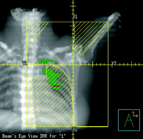 Figure 1A.  Frontal image (Beam's-eye-view (BEV)) depicting the position of the frontal 6 MV photon beam covering the supraclavicular fossa and axilla. Barred areas are shielded. Green areas represent regions with post-RT density changes.