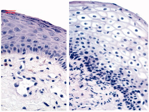 Figure 1. 40× magnification shows an average epithelial thickness of patient No.2 before the treatment (left picture) of 106 μm (85–120 μm) with an average of 9 (7–11) layers of cells and no glycogenic load, and after the treatment (right picture) 183 μm (160–215 μm) average of epithelial thickness with an average of 21 (15–25) layers of cells, with a significant amount of glycogen and basal cell hyperplasia.