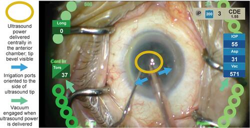 Figure 7 A representative image showing intraoperative phacoemulsification tip positioning, irrigation ports, fluidics, and ultrasound delivery.