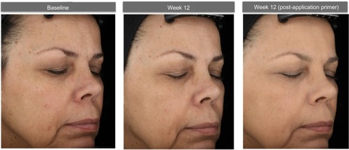 Figure 6 Photographs of a 62-year-old subject with Fitzpatrick skin type IV: baseline (left photo) and after 12 weeks of test product (without primer applied [center photo] and with primer applied [right photo]).