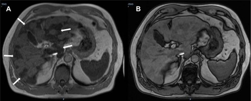 Figure 20 MRI showing focal iron.