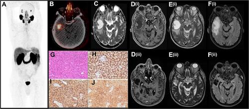 Figure 2 [68Ga]Ga-PSMA-11 PET/CT and MRI findings in the patients showing heterogeneous mass in the right temporal region with central cystic components and peripheral solid components surrounded by peri-lesional edema finally diagnosed as intracranial metastasis due to prostate cancer. (A) [68Ga]Ga-PSMA-11 PET/CT MIP image from vertex to upper tight; (B) trans-axial PET/CT superimposed image showing increased radiopharmaceutical uptake at the right temporal lobe, further confirmed by MRI study; (C) trans-axial ADC map; (D(i), D(ii)) trans-axial contrast-enhanced T1-weighted images; (E(i), E(ii)) trans-axial T2-weighted images; (F(i), F(ii)) trans-axial FLAIR images; (G–J) At histopathological level, the tumor cells presented with rounded nuclei with small nucleoli, forming acinar structures (G), and expressed ERG (nuclear staining) (H), PAP (I) e PSA (J).