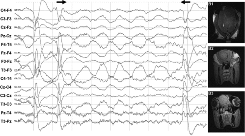 Figure 7. EEG showing generalised slow delta waves. MRI showed a left-sided space-occupying mass identified as an abscess. (a) Generalised rhythmical slow delta waves (1 Hz and amplitude of 20–100 μV) (between arrows) suggestive of an intracranial space-occupying mass (patient 5). Scale: amplitude 50 μV/division and 1 second/division. (b) B1 – space-occupying mass indicative of abscess (grey circle on the upper right part of the figure) in the dorsal view of the left hemisphere of the cerebrum; B2 – caudal view; B3 – expansion of the mass between the eyes in the caudal view.