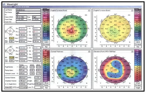 Figure 8 Case no 6. Preoperative Pentacam 4 map.