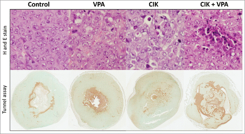 Figure 7. CIK cells infiltration and apoptosis in tumor tissue. More CIK cell infiltration and apoptosis were observed in CIK cells + VPA combination treatment group than CIK or VPA single treatment mice tissue. Apoptosis of each group was evaluated in TUNEL assay. Percent of positivity is 24.31 ± 6.28% in control, 28.31 ± 2.30% in VPA treated mice, 28.77 ± 4.50% in CIK cell treated mice, and 38.30 ± 2.79% in combination treatment mice.