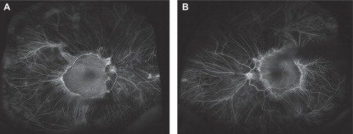 Figure 3 Ultrawide-field fluorescein angiography of gyrate atrophy (Optos Imaging System).