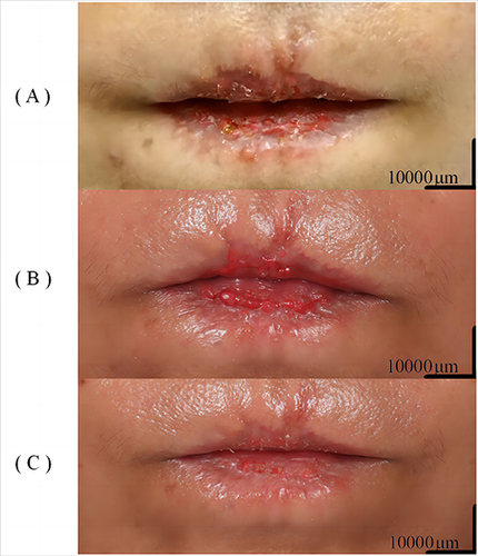 Figure 1 Various stages of treatment for the Case. (A) Baseline; (B) After two months of treatment with 2% Crisaborole Ointment; (C) After undergoing one session of Q-switched 532nm Nd:YAG laser treatment.