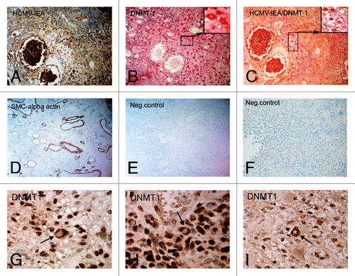 Figure 6. DNMT1 translocates from the nucleus in HCMV infected cells in intestinal tissue specimens obtained from IBD patients. Sections were stained for (A) HCMV-IE protein expression (brown, DAB, 20X magnification), (B) DNMT-1 protein expression (Red, Fast Red, 20X magnification), (C) HCMV/DNMT-1 double staining (Fast Red/DAB, 20X magnification), (D) SMC α-actin (DAB, 10X magnification), (E and F) Negative control without primary antibody. Cytoplasmic localization of DNMT1 was also investigated in 3 additional IBD patients. In all of them, cells with cytoplasmic localization of DNMT1 were observed as indicated by arrows (G-I).