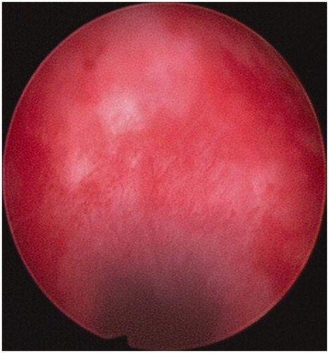 Figure 4. The pregnancy tissues were removed from the previous caesarean scar.