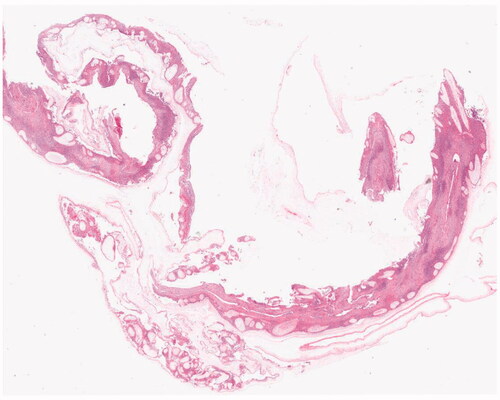 Figure 3. Pathology of the placenta of a pregnant woman infected with Listeria monocytogenes in the third trimester of pregnancy. At 37w of pregnancy, placental pathological chorionic vasodilatation, hyperemia, with local bleeding, chorioamnionitis: stage II, grade III.