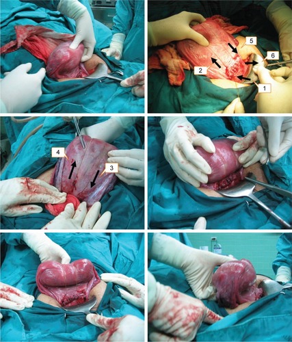 Figure 1 Uterine flexion suture technique.