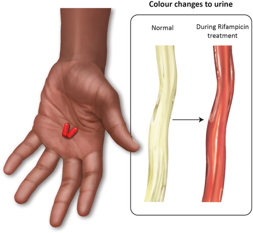 Figure 7. Adherence: ‘But the problem has to do with rifampicin, when they take rifampicin, you realise their urine colour changes to red. So, sometimes they feel very nervous.’ This figure represents an open hand holding two capsules as a friendly gesture. Alongside it are examples of urine colour. One is normal, the other red, designed to make the patient aware of such a change. Knowledge is empowerment for the patient. This reflects the sense of sight. Illustration by Joanna Butler.