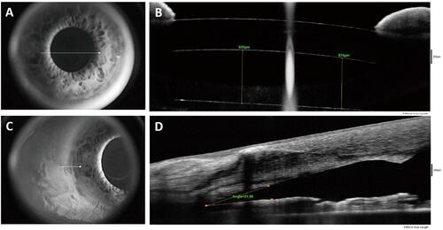 Figure 3 Position of the primary and the trifocal supplementary IOL (B) in the eye.Notes: (A, B) An interlenticular space of approximately 874–935 µM minimizes the risk of interlenticular opacification. (C, D) Cornea angle is wide enough (21.69°) to maintain physiological function of the anterior segment and to prevent secondary glaucoma. All photographs were taken 6 months postoperatively.Abbreviation: IOL, intraocular lens.