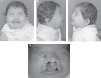 Figure 5 A–D Clinical aspects of case 2. Note in 5D facial aspects before surgical correction.