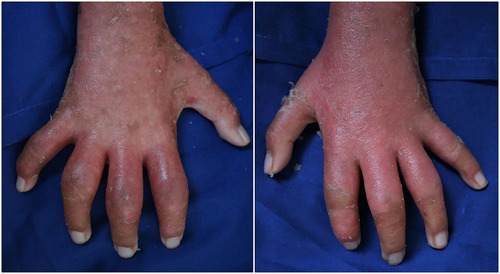 Figure 1 Clinical manifestation of PA. Dactylitis on all fingers of the right and left hands.