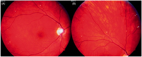 Figure 2. Photographs of the patient’s right eye fundus. A: posterior pole; B: periphery of the fundus. White spots overlie retinal vessels.