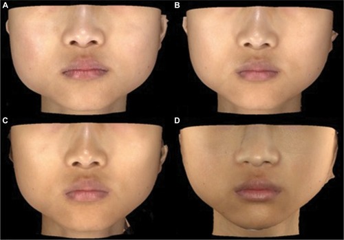 Figure 4 Patient at baseline (A), week 6 (B), week 16 (C), and week 20 (D) after the injection of incobotulinumtoxinA using MIT for the treatment of masseter hypertrophy.
