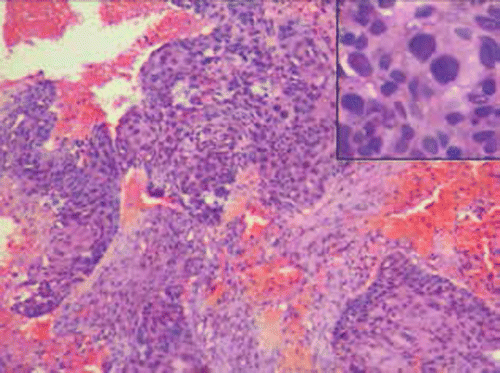 Figure 4: A histological examination of the cervical biopsy shows strips of malignant squamous cells with intracytoplasmic keratinisation (inset) along with area of necrosis and haemorrhage, using haematoxylin and eosin staining