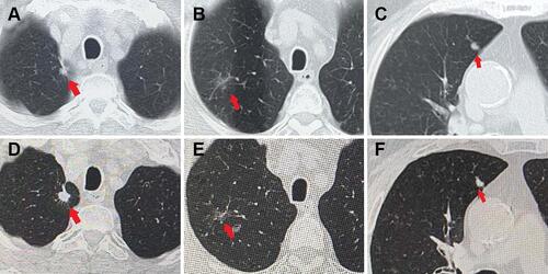 Figure 1 In August 2019, three nodules were found during physical examination. (A–C) shown tumor A, tumor B and tumor C, respectively; In July 2020, increased nodular diameter and density were observed at follow-up. (D–F) shown tumor A, tumor B and tumor C, respectively. The red arrows show pulmonary nodules.