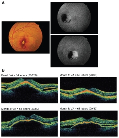 Figure 5 A 61-year-old female patient with a normal right eye having received no prior treatments was administered 4 injections of bevacizumab. A) Fundus photograph at baseline (left panel) and fluorescein angiography (right panel). B) Optical coherence tomography images and visual acuity (VA; Early Treatment Diabetic Retinopathy Study [ETDRS] letters) at baseline and months 1, 3, and 6.