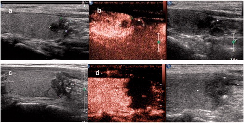 Figure 2. (a) Longitudinal ultrasound image demonstrating a 5 × 6×8 mm hypoechoic nodule with an irregular margin and microcalcifications located in the right thyroid lobe. (b) Contrast-enhanced ultrasound (CEUS) of the nodule showing irregular hypoenhancement. (c) Ultrasound showing a heterogeneous hypoechoic area with hyperechoic foci 1h after the end of MWA. (d) CEUS was performed to evaluate the 14 × 14 × 17 mm extensive ablation area 1 h after MWA.