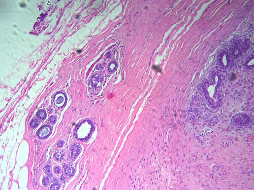 Figure 2. Breast fibroadenoma (demonstrated by Hematoxylin and Eosin staining (X 100).