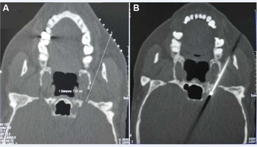 Figure 3 Puncture at foramen ovale performed under CT guidance.