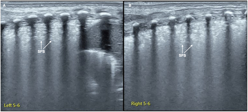 Figure 2. SFS. On the B-mode ultrasound, we can see a kind of specific lung consolidation, which is characterized by an obvious spot and patchy or thin line air-bronchograms in the lesion area, forming a snowflake-like manifestation, known as SFS. SFS is a characteristic ultrasound finding of grade II and above RDS.