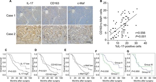 Figure 5 CD163 and c-Maf expression positively correlates with IL-17+ cell and predicts poor survival of NSCLC patients.Notes: (A) Serial whole tumor sections from 85 NSCLC patients were used, and representative cases of immunohistochemistry staining of IL-17, CD163 and c-Maf are shown (magnification, 200×). Scale bar represents 0.1 mm. (B) Significant positive correlations were found between the IL-17 expression and CD163+ c-Maf+ cells. (C–E) Kaplan–Meier curves of overall survival analysis between NSCLC patients. Patients with high expression of IL-17, CD163 and c-Maf had significantly poorer overall survival than patients with low expression. (F, and G) NSCLC patients were classified into the following four groups: group I, IL-17+ CD163+ c-Maf+; group II, IL-17-CD163-c-Maf–; group III, IL-17+ CD163-c-Maf– and group IV, IL-17+ CD163+ c-Maf– and IL-17+ CD163-c-Maf+. The survival rates in group I were significantly lower than those in group II. P-values were determined by the log-rank test.Abbreviations: IL, interleukin; NSCLC, non-small-cell lung cancer.