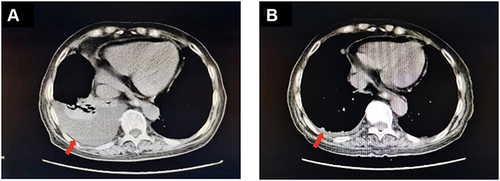 Figure 1 Chest imaging. (A) A moderate amount of liquid density shadow in the chest cavity bilaterally, mainly on the right side, with a CT value of 5 HU. Adjacent lung tissue was compressed by pleural fluid. (B) Pleural fluid was almost completely absorbed. The red arrow indicates the site of pleural fluid.