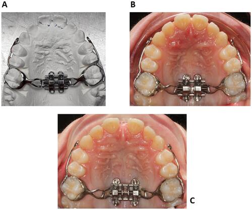 Figure 9 (A) Finalized MSE appliance on the dental stone model. (B) MSE appliance after placement in the patient oral cavity. (C) Intraoral picture after maxillary expansion.