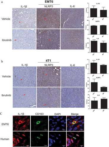 Figure 5. BTK inhibition reduces NLRP3 inflammasome activity in vivo. Female BALB/c mice were injected with (a) EMT6 or (b) 4T1 cells in the mammary fat pad to produce tumors. n = 8 mice per tumor model. Ibrutinib or vehicle was administered by drinking water at 25 mg/kg daily for 10 days. Tumors were harvested and stained for IL-1β, NLRP3, and IL-6 via immunohistochemistry. Ibrutinib treated mice showed reduced amounts of staining (indicated by red arrow) for IL-1β and NLRP3. IL-6 was used as a control with the expectation that it does not associate with the inflammasome and that its levels should not be affected by BTK inhibition. (c) Immunofluorescence staining of CD163 (marker of macrophages) and IL-1β in EMT6 murine and human breast tumors. Human breast tumor is from a patient with invasive lobular carcinoma that was positive for estrogen and progesterone receptors and negative for HER 2/neu.