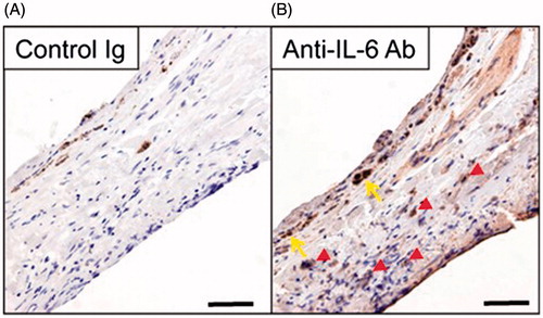 Figure 1. Expression of IL-6 in the stroma cells and a partially intact monolayer of RPE cells in human choroidal fibrovascular tissues from a patient with exudative AMD. Immunohistochemistry shows expression of IL-6 (B) in surgically excised AMD choroidal neovascular tissues, in the stroma (red arrowheads) and a partially intact monolayer of RPE cells (yellow arrows). The specificity of staining is confirmed by the absence of staining with isotype control IgG (A). Scale bars, 50 μm.