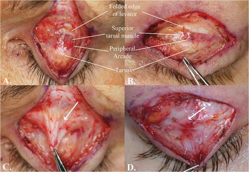 Figure 2 Intraoperative photographs, upper eyelid reconstruction. (A) and (B) Typical cases demonstrating a white-line levator aponeurosis dehiscence as labeled at top of figures. (C) Eyelid with a white-line levator disinsertion. Dense septal scar (arrow) caused by blepharoplasty surgery to remove superior anterior orbital fat is present. (D) Eyelid after Müller muscle-conjunctival resection-ptosis surgery. Inferior edge of the levator is scarred to the tarsus (arrow).