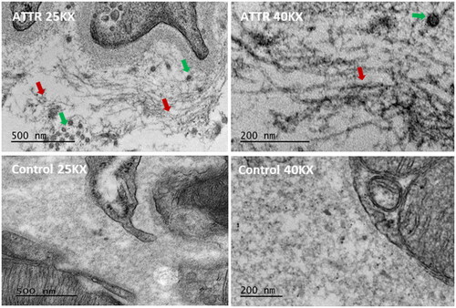 Figure 1. Transmission electron microscopy (TEM) shows immature (green arrows indicated dotted structures, magnification 25,000× and 40,000×) and mature (red arrows indicated thin, mesh-like, magnification 25,000× and 40,000×) amyloid fibrils in the cardiac extracellular matrix of ATTR mouse hearts compared to controls.