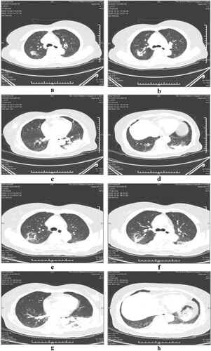 Figure 1. Serial chest computed tomography (CT) scans of the 72-year-old female with psittacosis pneumonia (the first patient). The initial CT scan (4 days after the onset) shows consolidations with bronchograms in the right upper lobe (a, b) and left lower lobe (c, d). The follow-up CT scan (13 days after the onset) shows the area of consolidation in the right upper lobe has decreased (e, f), while the consolidations in the left lower lobe only changed a little (g, h).