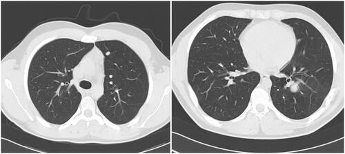 Figure 2. Chest TDM showing first and second pulmonary relapse.