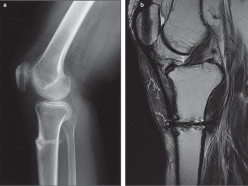 Figure 5. Lateral-view radiograph (a) and MRI (b) taken 3 years after the operation. Bone union is obtained well and the Insall–Salvati index is 1.6 (the opposite knee is 1.1). Therefore, the patella alta is seen. The graft is shown as a dark band on the T2-weighted image (b).