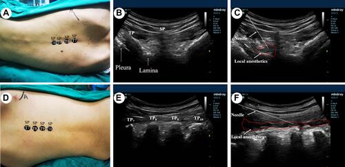 Figure 1 Schematic diagram of nerve block puncture: (A) The seventh thoracic vertebra (T7) that located at inferior angle of the scapula was first specified, and then T8, T9, T10 were successively marked. The laminae corresponding to the T8, T9 and T10 were identified according to the marked vertebra by ultrasound scanning. (B) Convex array probe of 1–5Hz is placed at the median transverse section of the centrum and is used to identify the lamina, pleura, spinous process (SP), and transverse process (TP). (C) A puncture needle is introduced in the plane. Local anesthetic is injected behind the lamina, and the spread of local anesthetic is observed in real-time. (D) The seventh thoracic vertebra (T7) that located at inferior angle of the scapula was first specified, and then T8, T9, T10 were successively marked. The laminae corresponding to the T8, T9 and T10 were identified according to the marked vertebra by ultrasound scanning. (E) Convex array probe of 1–5Hz is placed at the paravertebral sagittal view to identifying TP through the long spinal axis. (F) A puncture needle is introduced in the plane. A local anesthetic is injected at the erector spinal plane, and the spread of the local anesthetic is observed in real-time.