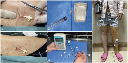 Figure 2. The process of CVC thrombolysis. (a&b) the vascular sheath of the PMT thrombectomy access was replaced by a 5 F one-lumen CVC secured with transdermal sutures. (c&d) the thrombolytic drug in the reservoir bag was loaded into the portable infusion pump, which was adjusted to the adequate dosage. (e) the infusion pump was connected to the CVC and turned on, which allowed patients to freely move their lower limbs and even ambulate during the period of thrombolysis.