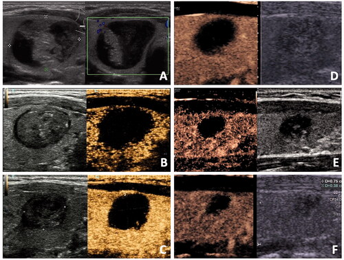 Figure 3. CEUS and US images of a 33-year-old female with a benign thyroid nodule after RFA. (A) Before RFA, US image showed a predominantly solid thyroid nodule located in the right lobe with an initial volume of 5.32ml. (B) At 1 month after RFA, Vt and Va were 1.58 ml and 1.41 ml, respectively. (C) At 3 months after RFA, Vt and Va were 0.88 ml and 0.73 ml, respectively. (D) At 6 months after RFA, Vt and Va were 0.75 ml and 0.63 ml, respectively. (E) At 12 months after RFA, Vt and Va were 0.32 ml and 0.21 ml, respectively. (F) At 24 months after RFA, Vt and Va were 0.18 ml and 0.08 ml, respectively.