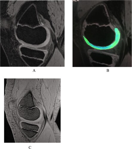 Figure 1. Healthy volunteer male 10 years old. (A) 3D-DESS image shows intact articular cartilage morphology of the medial femoral condyle of the left knee with a smooth surface and no obvious signal abnormality. (B) The T2 mapping pseudo-color image shows uniform distribution of cartilage color scale and intact articular surface distribution. (C) MRI SWI image shows intact articular cartilage morphology with a smooth surface and no magnetic sensitive low signal shadow in the joint space.