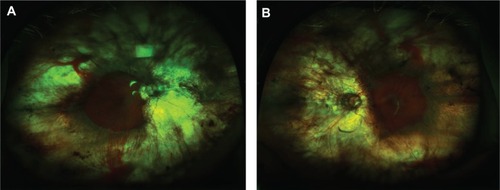 Figure 1 Ultrawide-field fundus photography of gyrate atrophy (Optos Imaging System). Extensive chorioretinal atrophy with remaining central macula islands at the posterior poles demarcated by pigmented borders.